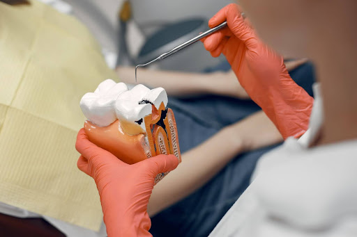 What Is a Root Canal and When Do You Need One?