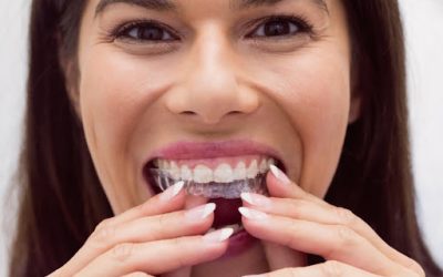 How Does Invisalign Dental Treatment Work?