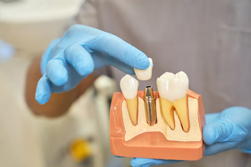 Single Tooth Implant Cost in India