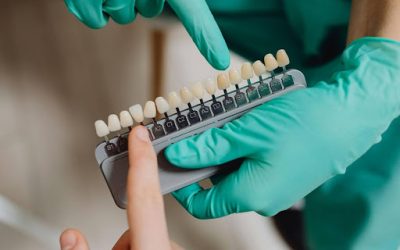 Top 10 Reasons for Professional Teeth Whitening