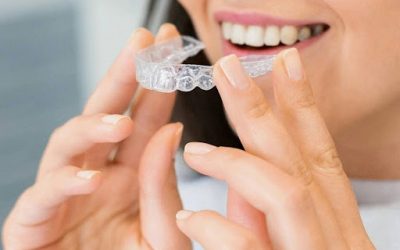 Clear Aligners vs. Traditional Braces Explained