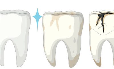 Tooth Decay: Causes, Symptoms & Treatment Options