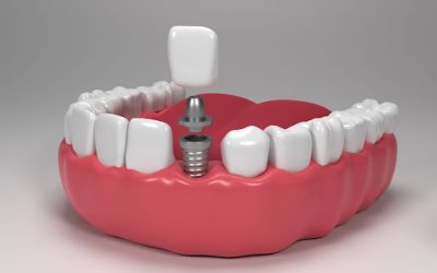 Benefits of Consulting an Implant Specialist for Tooth Replacement