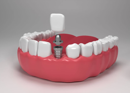 Benefits of Consulting an Implant Specialist for Tooth Replacement