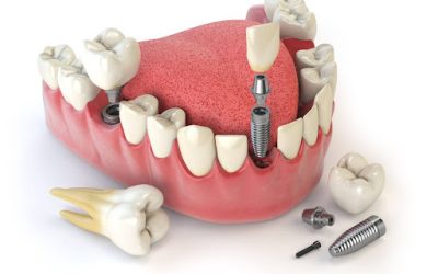 Why Dental Implants Are a Preferred Choice in Koparkhairane