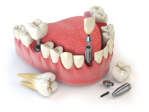 Dental Implants Are a Preferred Choice