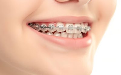 Smile Correction vs Braces: Which Is Better?