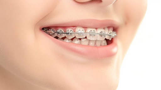 Smile Correction vs Braces Smile Correction vs Braces