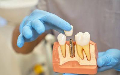 Different Types of Dental Implants Explained