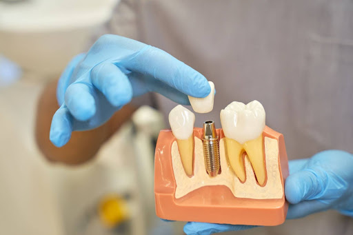 Different Types of Dental Implants Explained