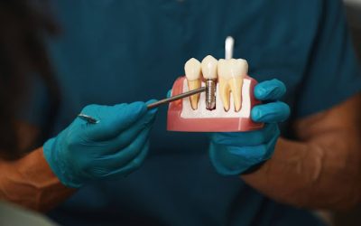 Dental Implants FAQs: Pain, Cost, and Aftercare