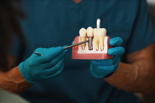Dental Implants FAQs: Pain, Cost, and Aftercare