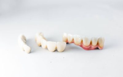 Implants vs Dentures vs Bridges: A Comparison