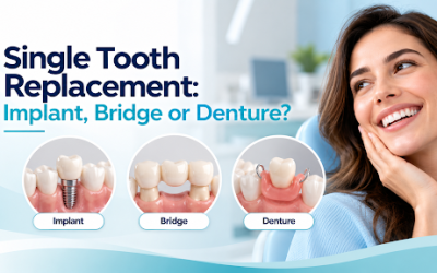 Single Tooth Replacement: Implant, Bridge or Denture?