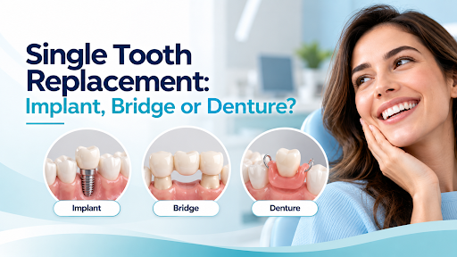 Single Tooth Replacement